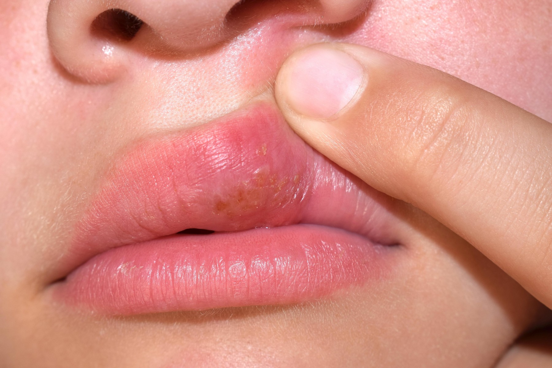 Herpes na usnama 