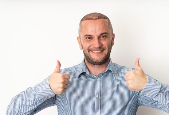 Presađivanje kose kod muškaraca Sve što morate znati prije nego se odlučite