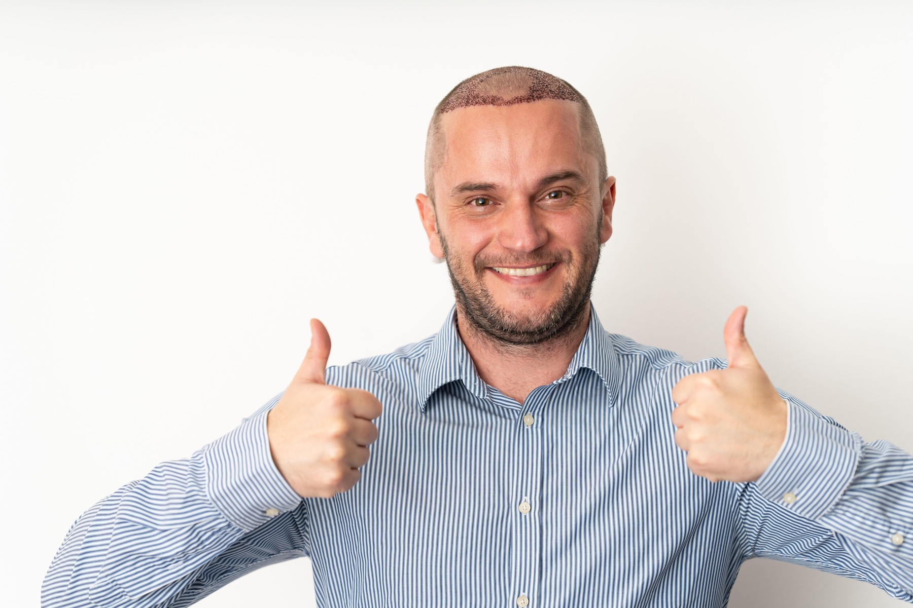 Presađivanje kose kod muškaraca Sve što morate znati prije nego se odlučite