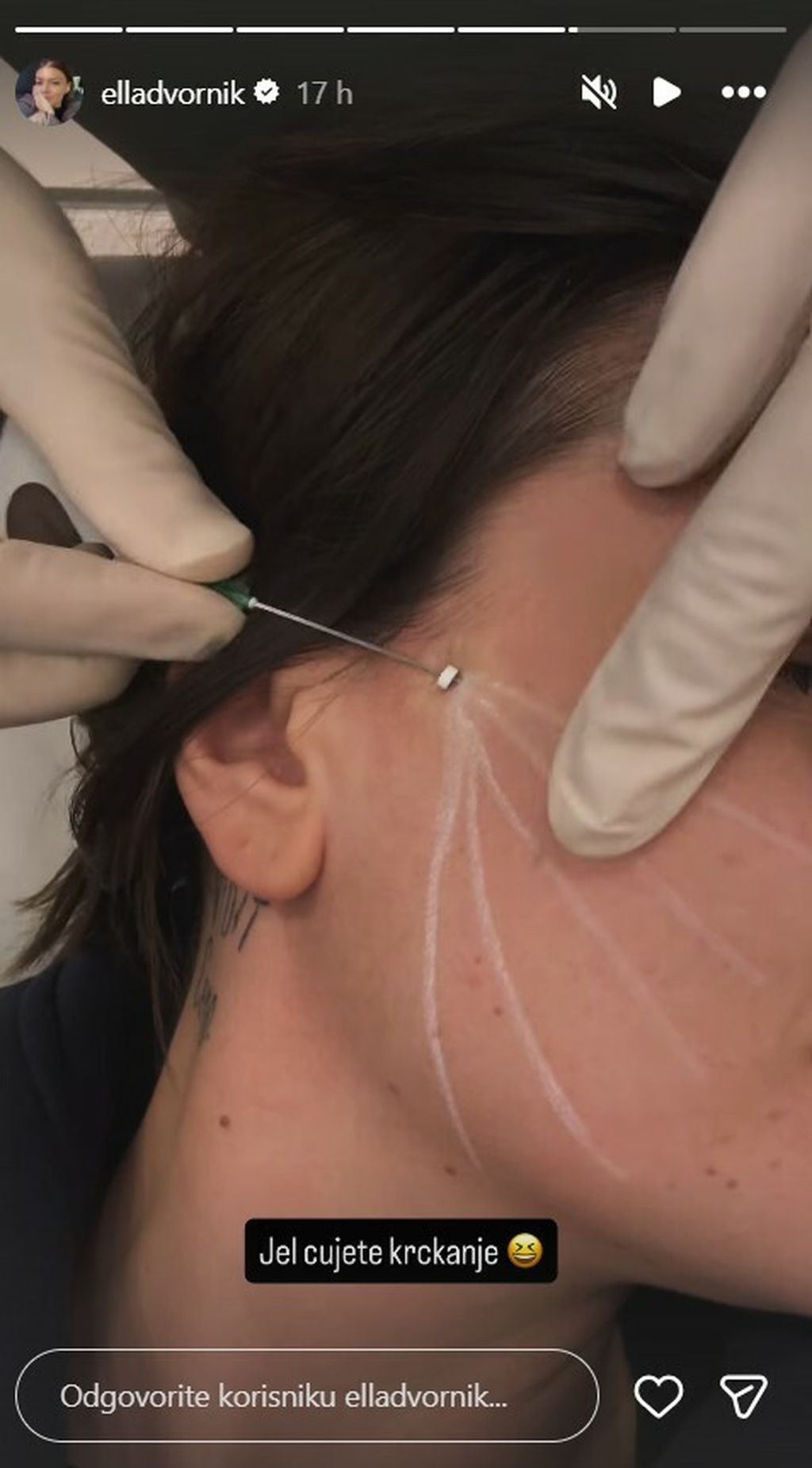 Ella Dvornik podvrgnula se zahvatu HELLO MAGAZIN CROATIA HRVATSKA