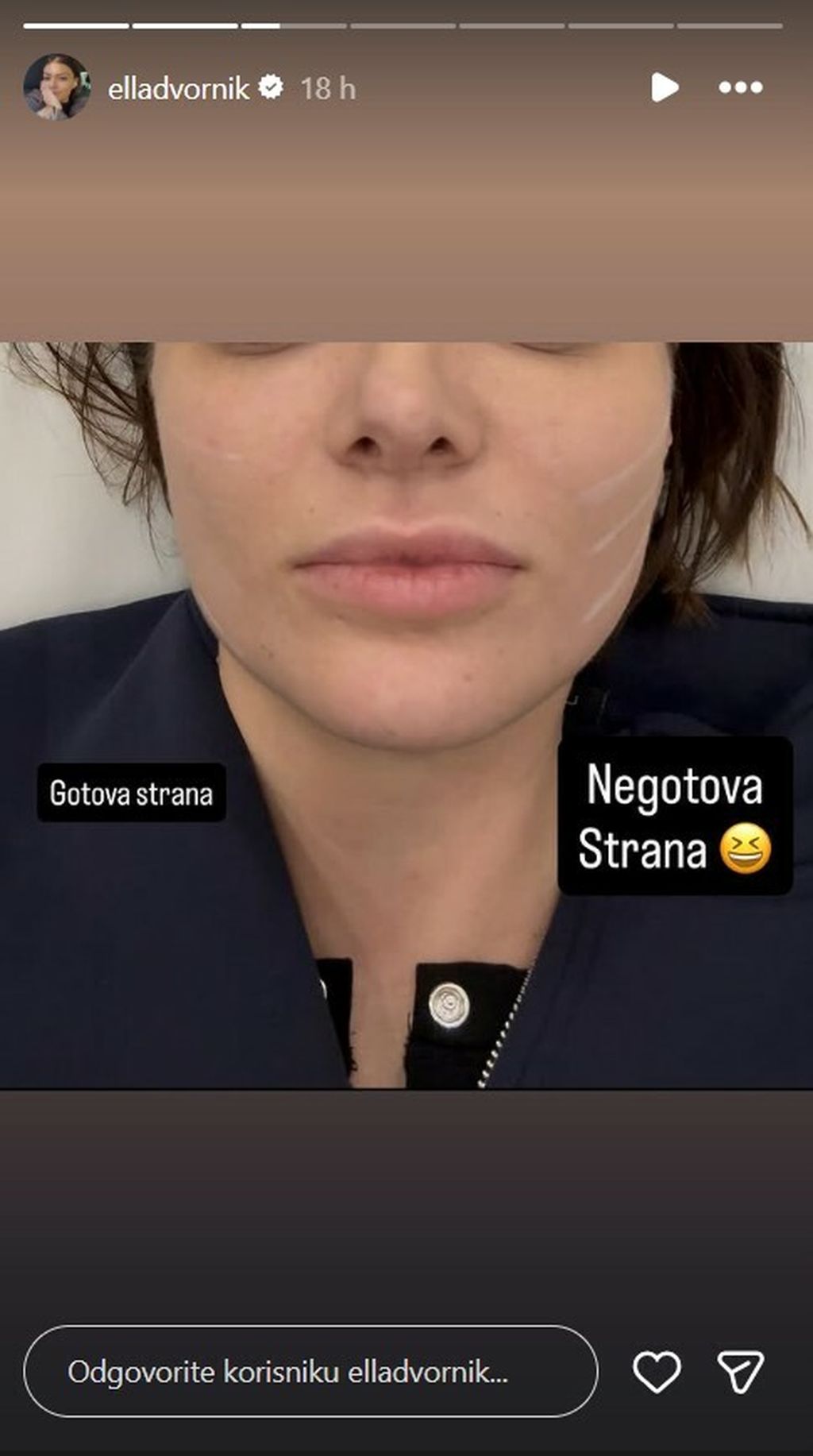 Ella Dvornik podvrgnula se zahvatu HELLO MAGAZIN CROATIA HRVATSKA