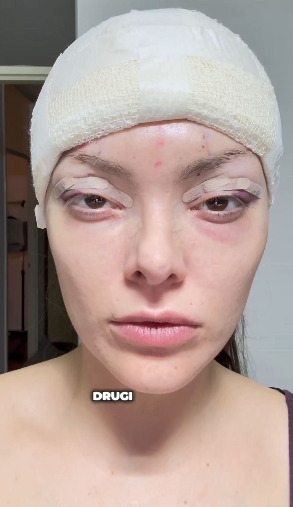 Ella Dvornik otvoreno o estetskim zahvatima HELLO MAGAZIN CROATIA HRVATSKA 67